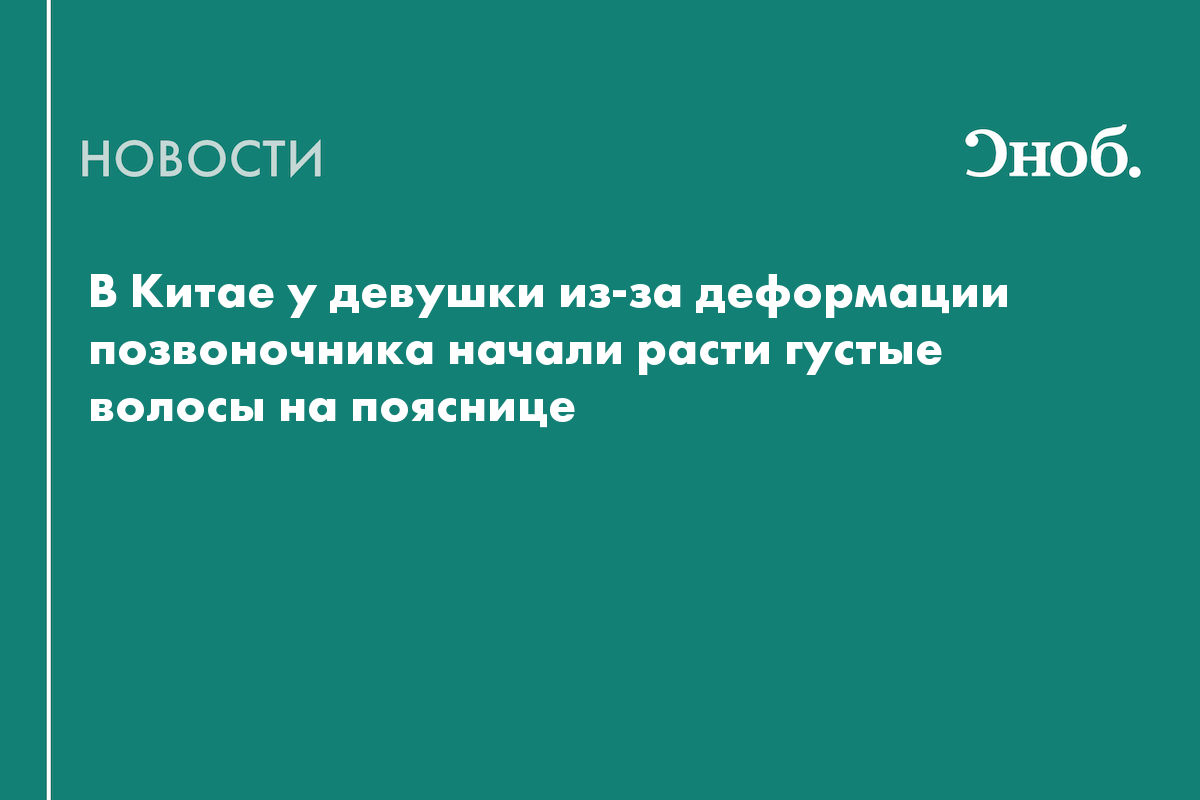 В Китае у девушки из-за деформации позвоночника начали расти густые волосы  на пояснице — Сноб